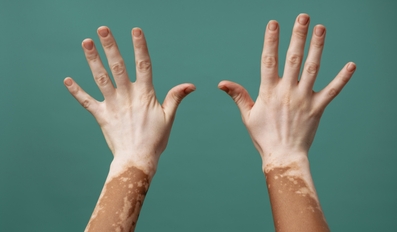 UAE Becomes First Country to Approve RINVOQ Oral Treatment for Non-Segmental Vitiligo